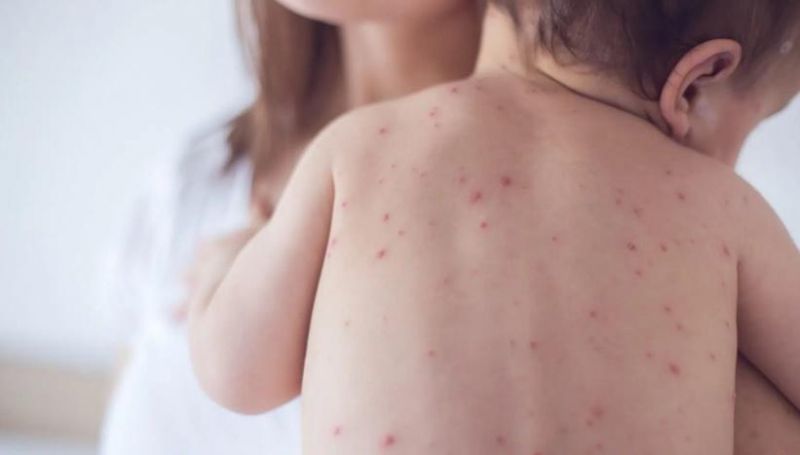 Sarampo volta a preocupar em Rondônia: risco de reintrodução exige atenção e vacinação em dia